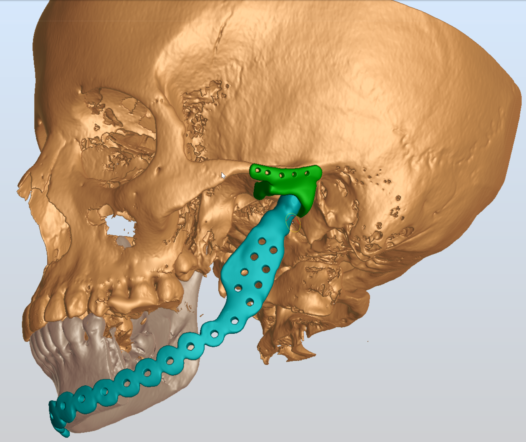 Patient Specific Implant